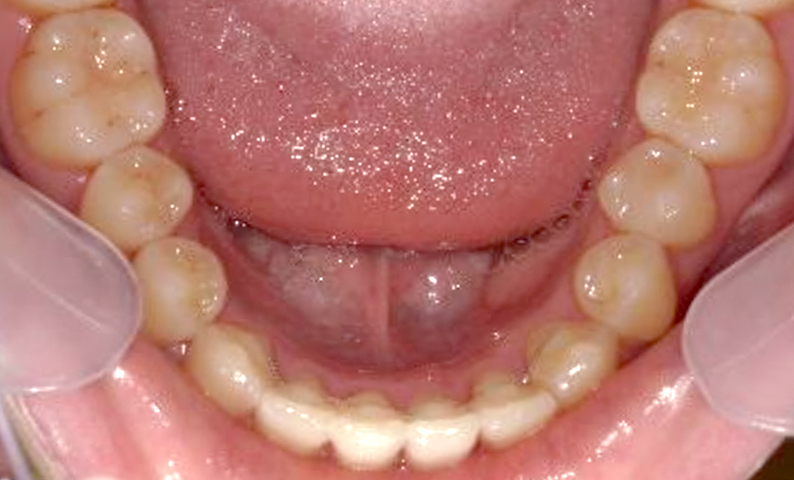 部分矯正 八重歯の症例写真