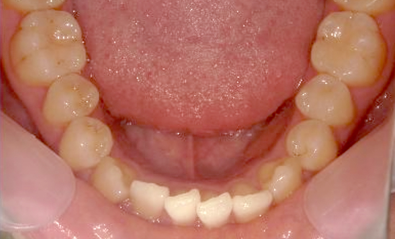 部分矯正 八重歯の症例写真