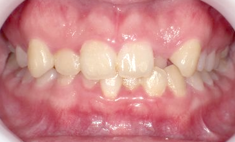 部分矯正 八重歯の症例写真