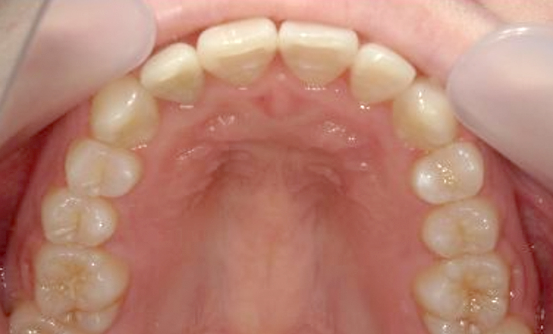 部分矯正 八重歯の症例写真