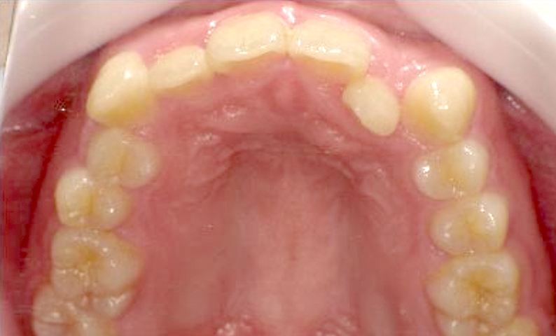 部分矯正 八重歯の症例写真