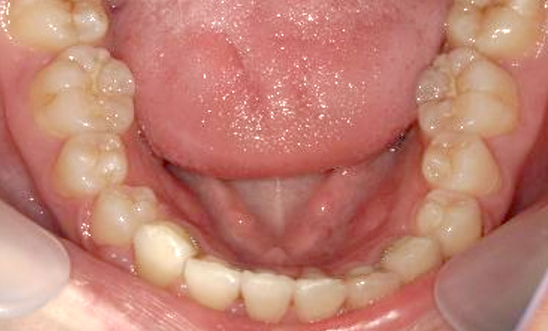 部分矯正 八重歯の症例写真