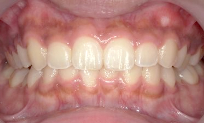 部分矯正 八重歯の症例写真