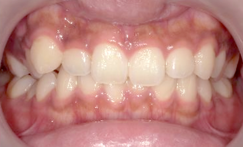 部分矯正 八重歯の症例写真