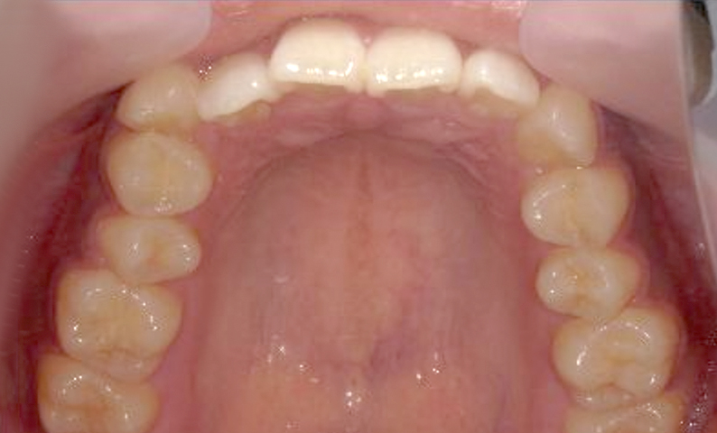 部分矯正 八重歯の症例写真