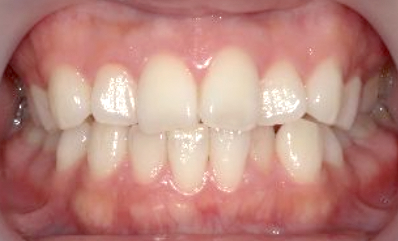 部分矯正 八重歯の症例写真