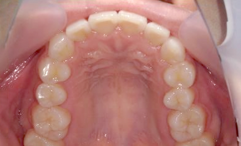 部分矯正 八重歯の症例写真