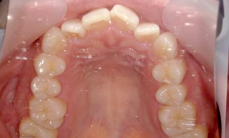 部分矯正 八重歯の症例写真