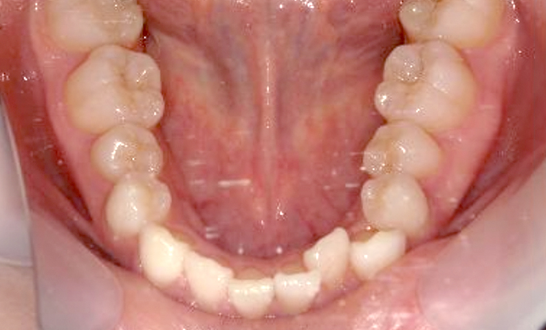 部分矯正 八重歯の症例写真