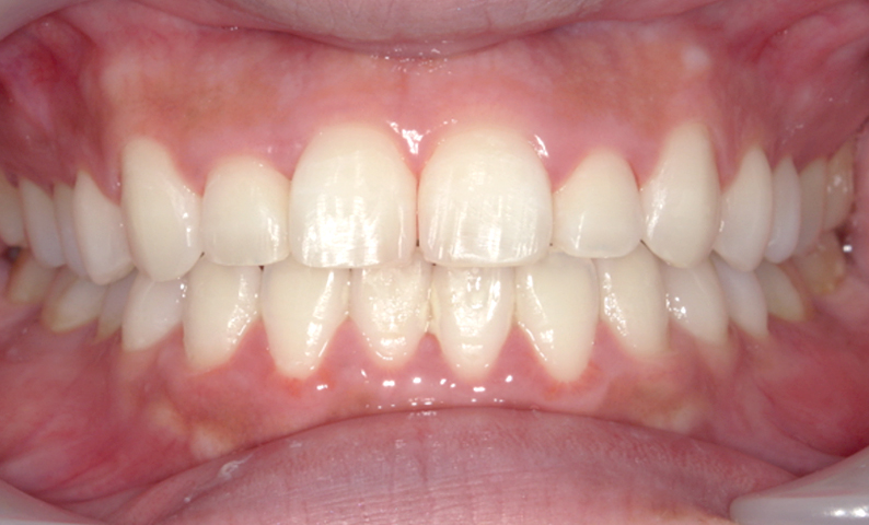 部分矯正 八重歯の症例写真