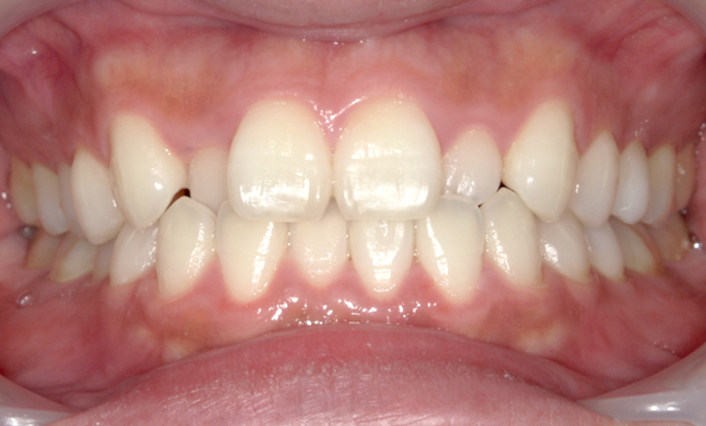 部分矯正 八重歯の症例写真