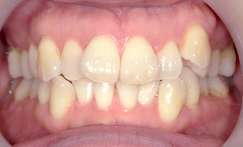 部分矯正 八重歯の症例写真