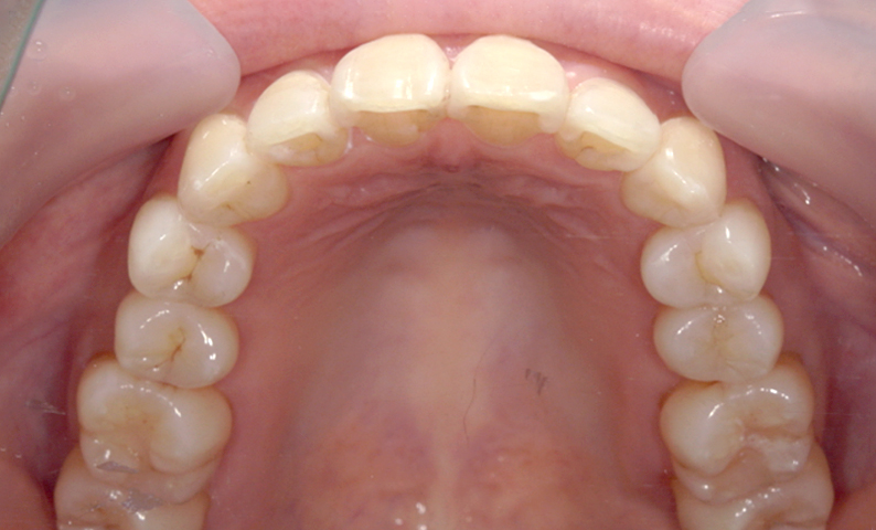 部分矯正 八重歯の症例写真