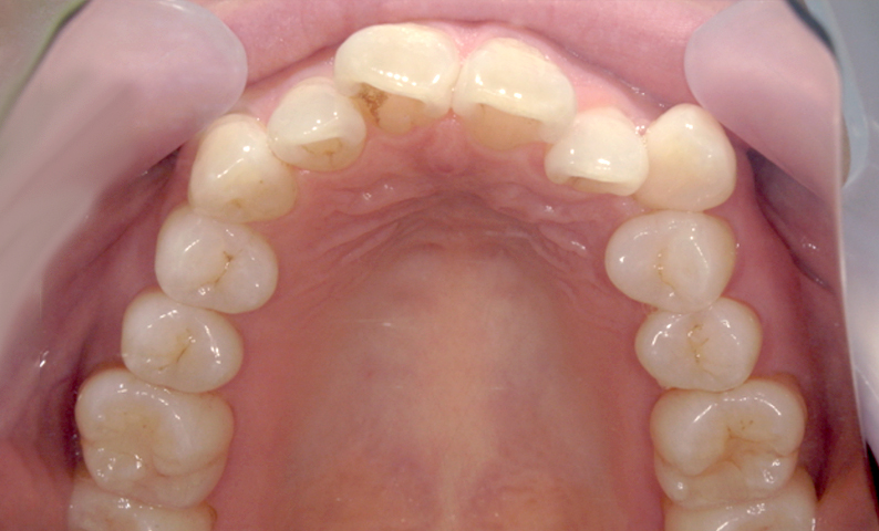 部分矯正 八重歯の症例写真