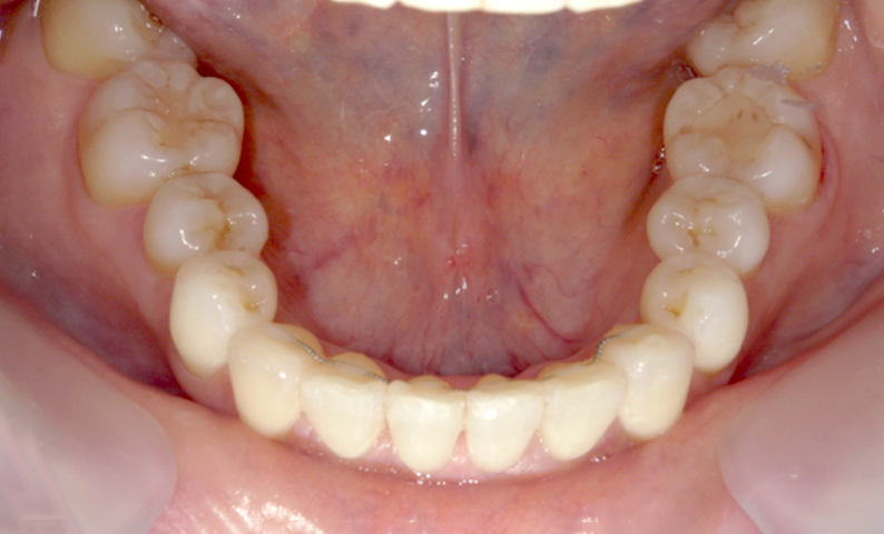 部分矯正 八重歯の症例写真