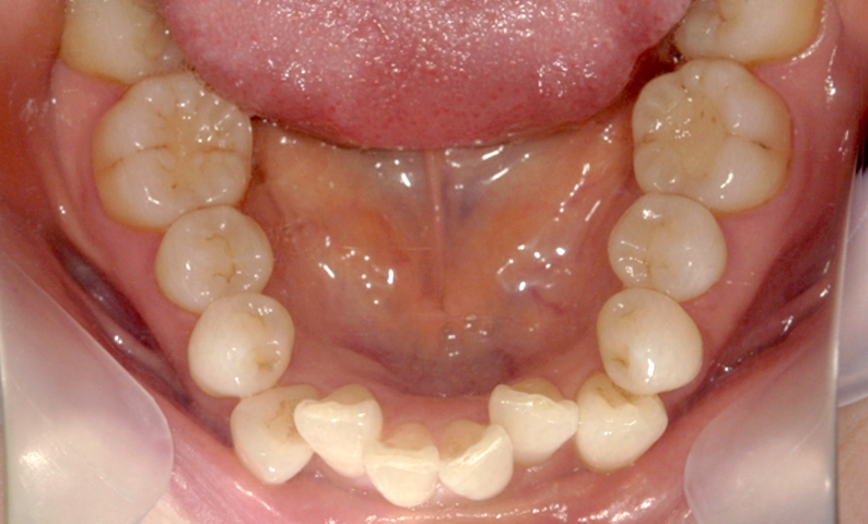 部分矯正 八重歯の症例写真