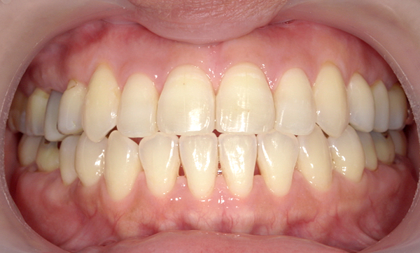 部分矯正 八重歯の症例写真