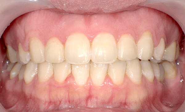 部分矯正 八重歯の症例写真