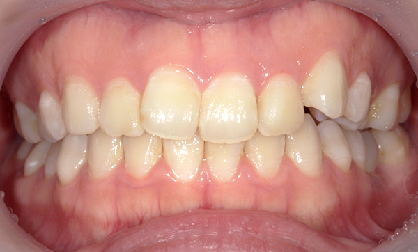 部分矯正 八重歯の症例写真
