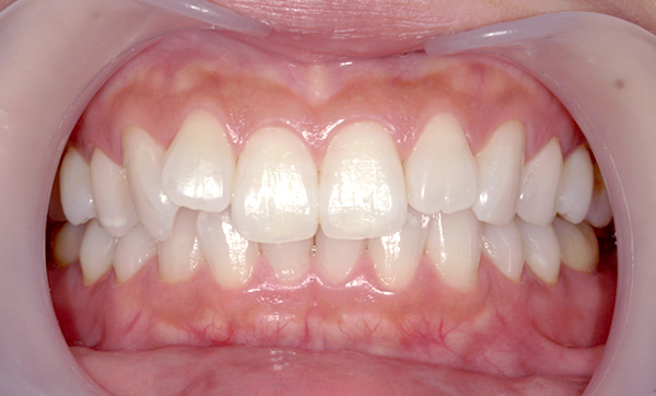 部分矯正 八重歯の症例写真