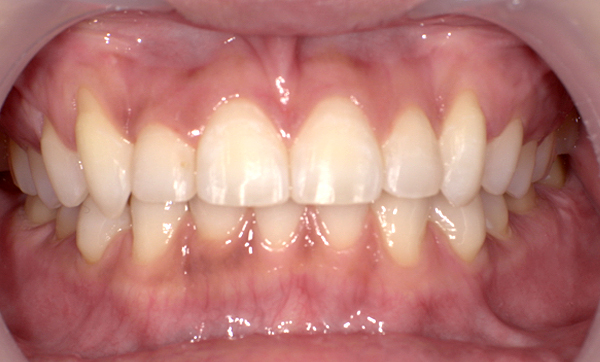 部分矯正 八重歯の症例写真