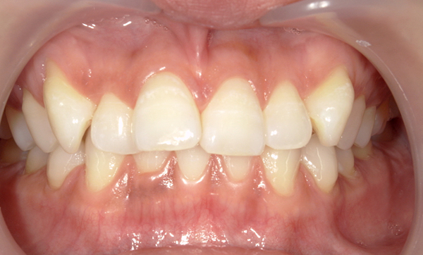 部分矯正 八重歯の症例写真