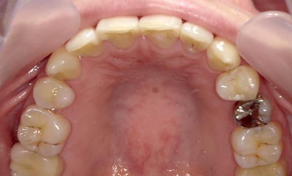 部分矯正 八重歯の症例写真