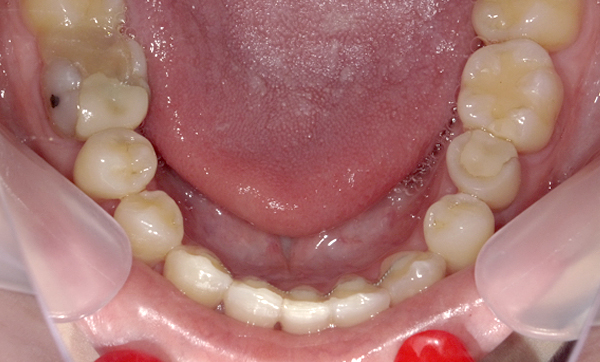 部分矯正 八重歯の症例写真
