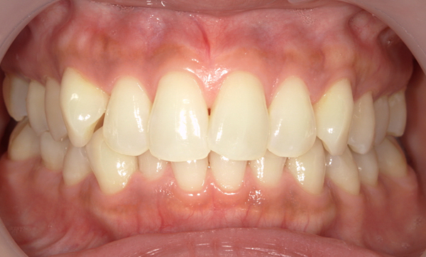 部分矯正 八重歯の症例写真