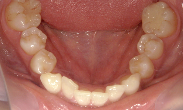 部分矯正 八重歯の症例写真