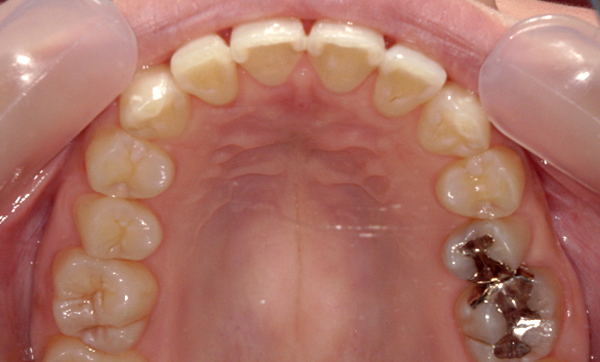 部分矯正 八重歯の症例写真