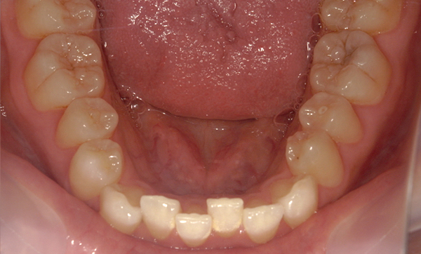 部分矯正 八重歯の症例写真