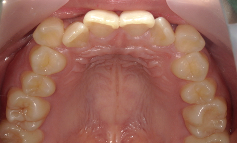 部分矯正 八重歯の症例写真