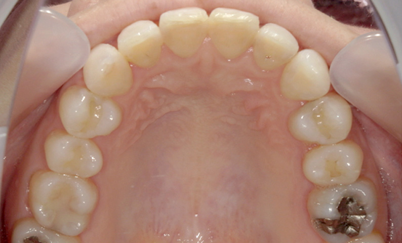 部分矯正 八重歯の症例写真