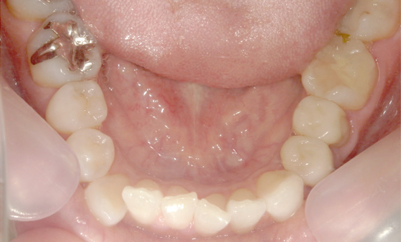 部分矯正 八重歯の症例写真