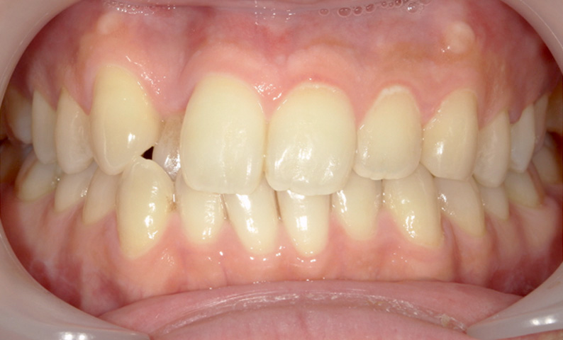 部分矯正 八重歯の症例写真