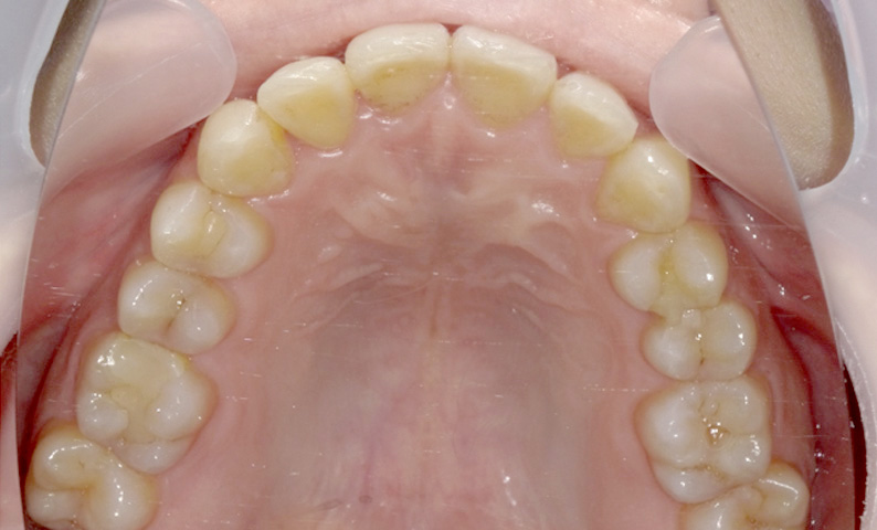 部分矯正 八重歯の症例写真