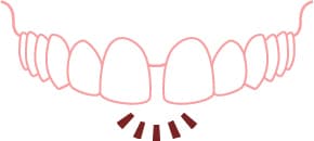 すきっ歯・歯の隙間