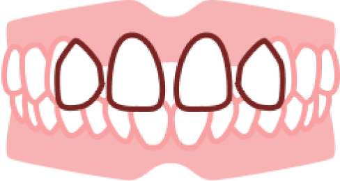 部分矯正のたつや歯科 すきっ歯