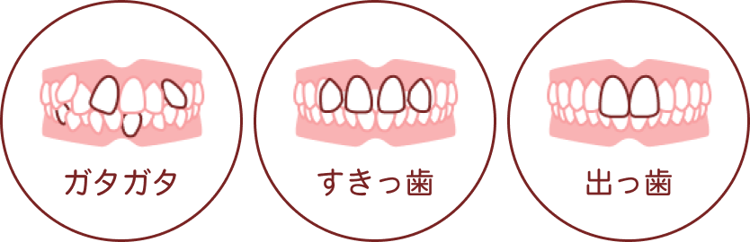 ガタガタ、すきっ歯、出っ歯