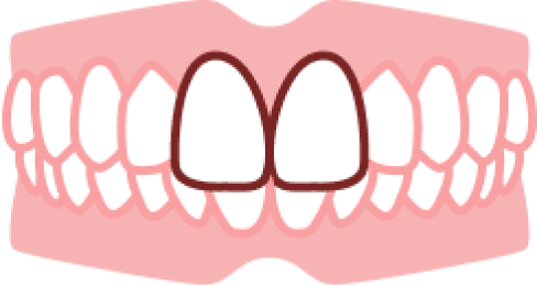 部分矯正のたつや歯科 出っ歯