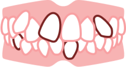 部分矯正のたつや歯科 ガタガタ