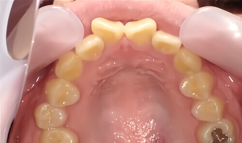 たつや歯科の部分矯正_タイプ別症例集_八の字/V字型
