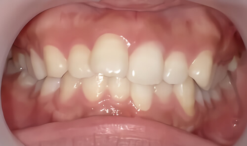 たつや歯科の部分矯正_タイプ別症例集_ねじれ/捻転歯