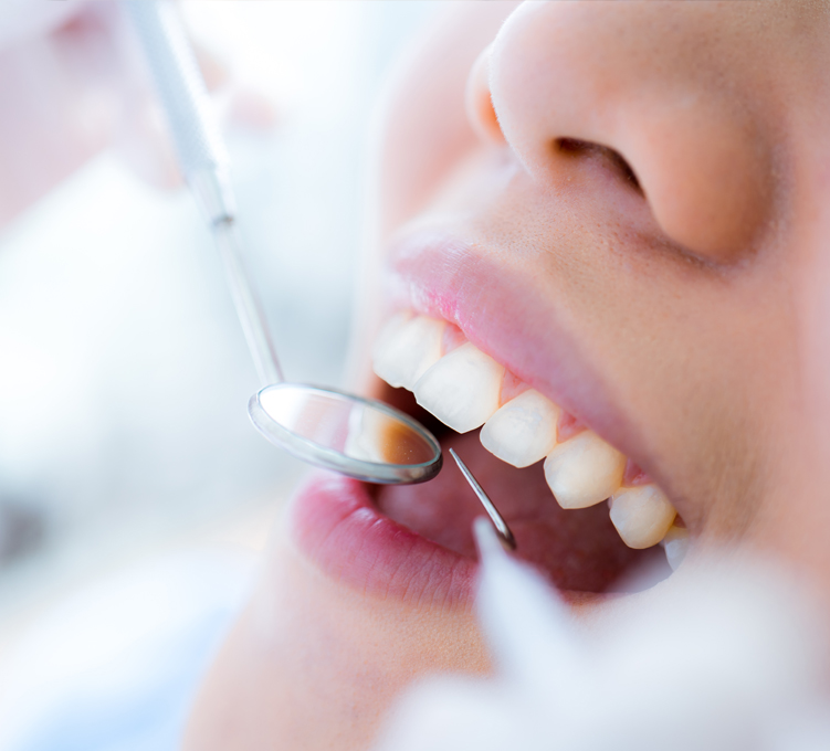 審美歯科 ホワイトニング