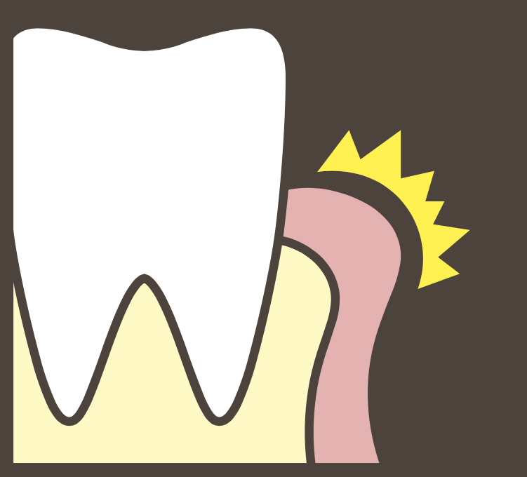 歯ぎしり・食いしばりが引き起こす全身への影響 歯ぐきに起こるトラブル